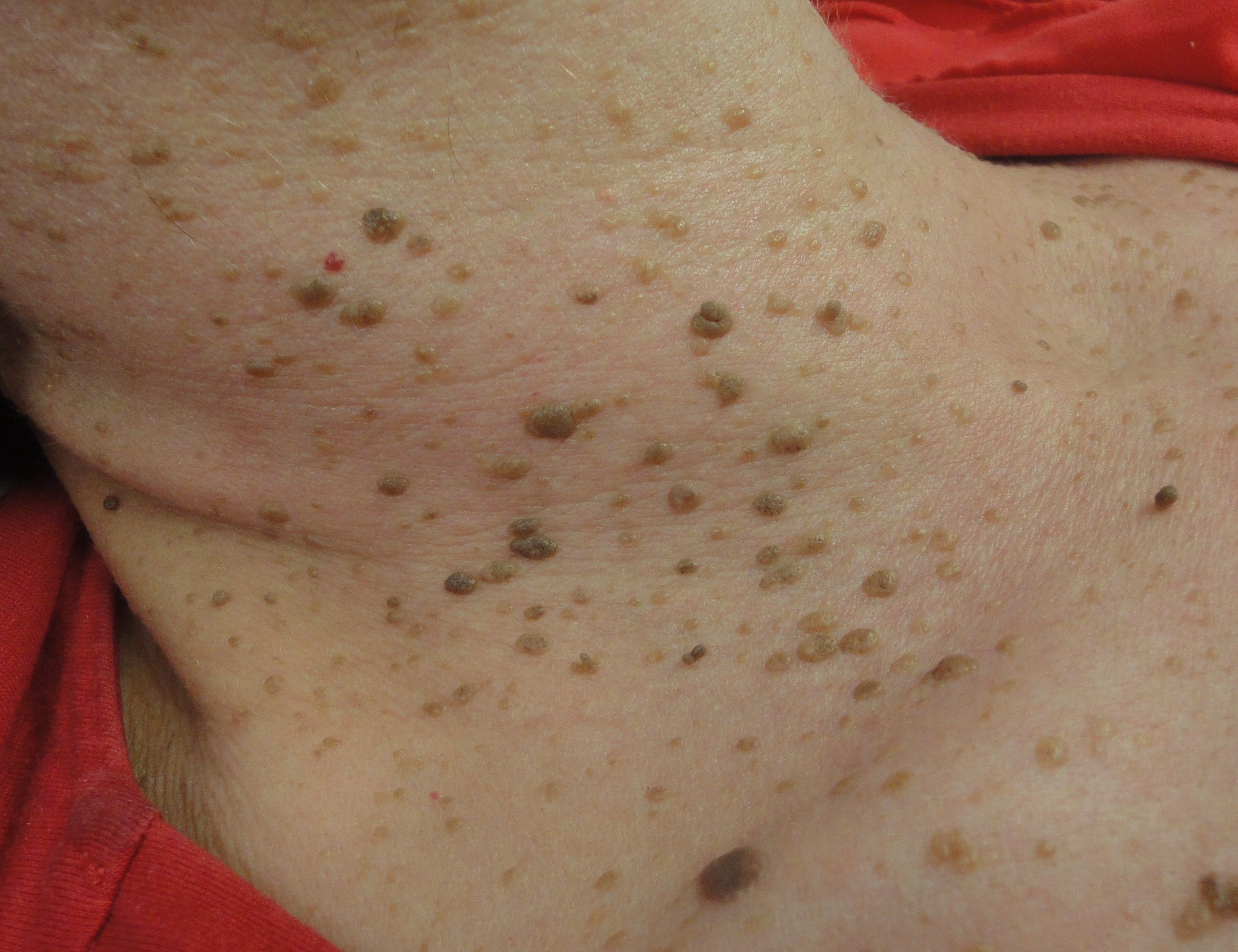 Seborrheic Warts Treatment